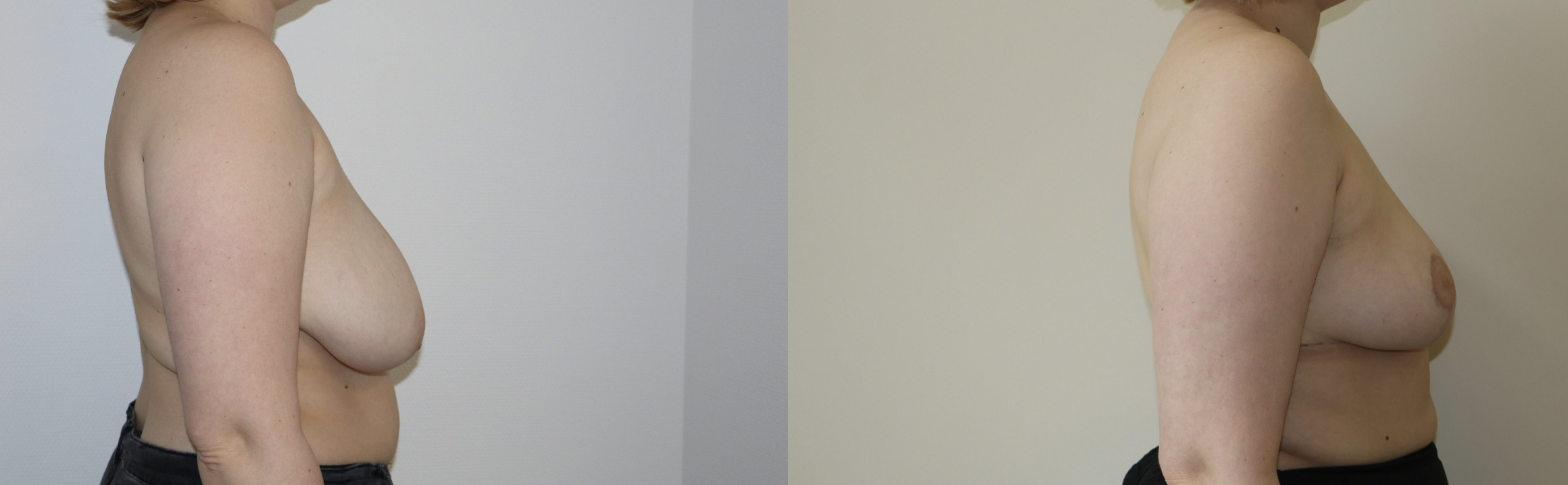 Avant/Après lifting seins et réduction mammaire